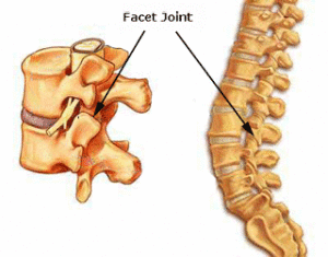 Facet-Joint