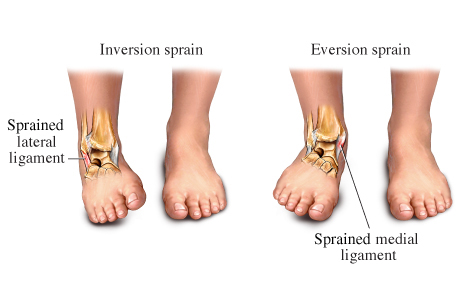 Ankle Sprains - Live Active Clinic
