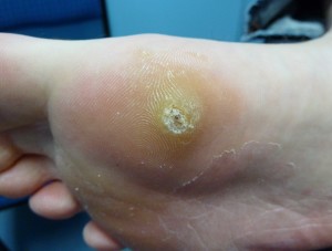 plantar-wart-8